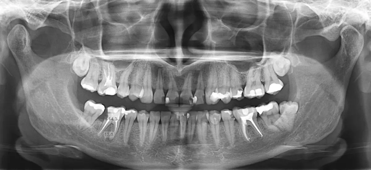 chirurgia stomatologiczna w Dental Pearl Mikołów